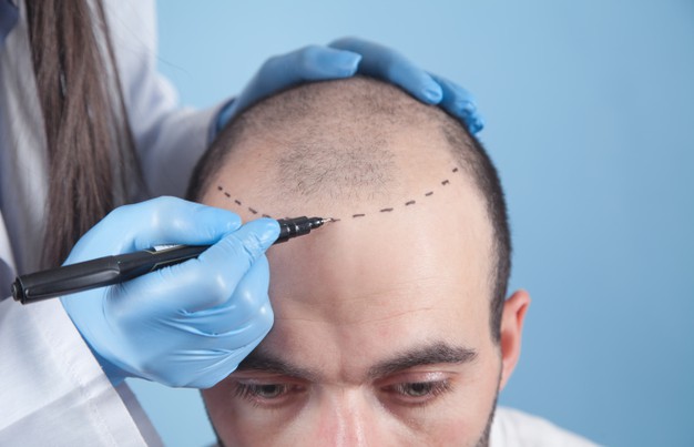 Hair Transplant